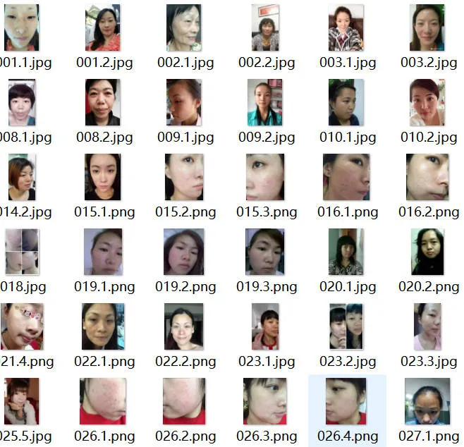 333套祛斑祛痘对比图资料包，无水印高清素材